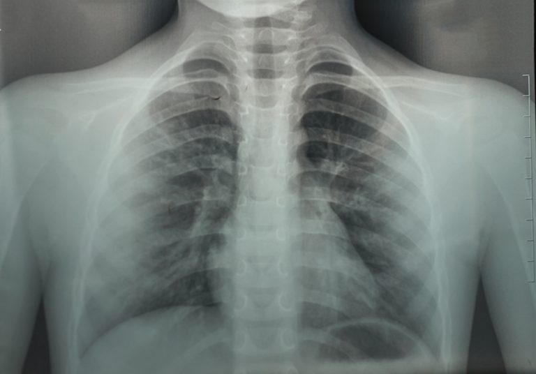Chest Xrays not reliable in diagnosing COVID19 respiratory infections